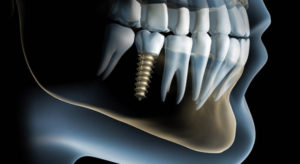 implanty stomatologiczne Medicodent Kielce