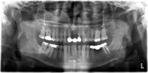 RTG zębów - radiologia stomatologiczna