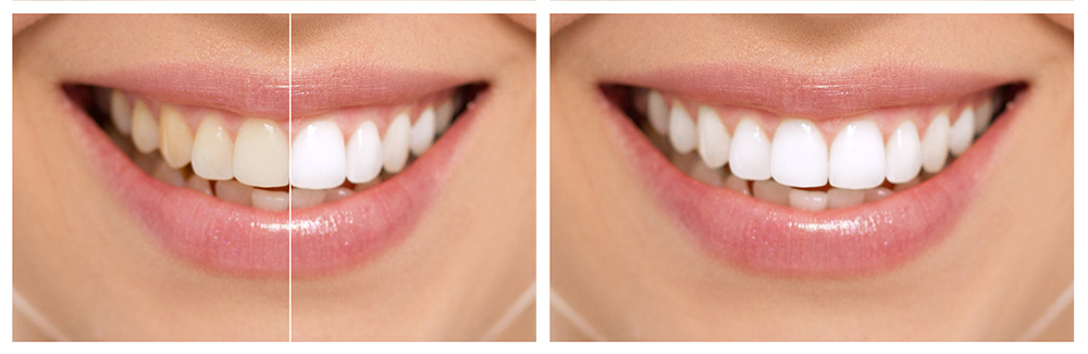 zadbaj o swój uśmiech - wybielanie zębów przed i po