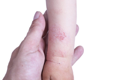 Eczema on the kid's hand